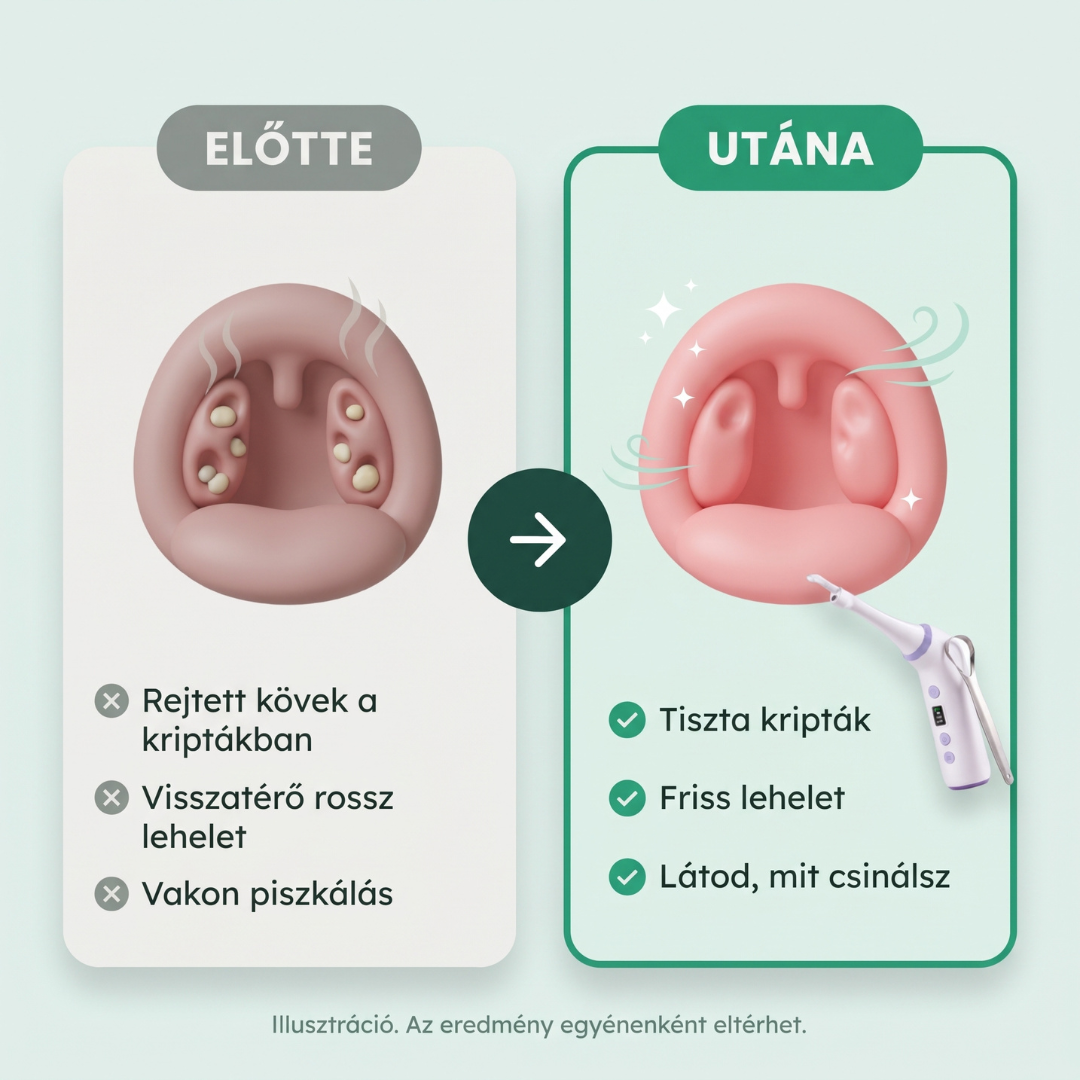 Tonsillo Mandulakő eltávolító